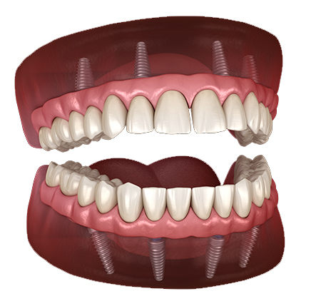 All-on-Four-Dental-Implants.jpg
